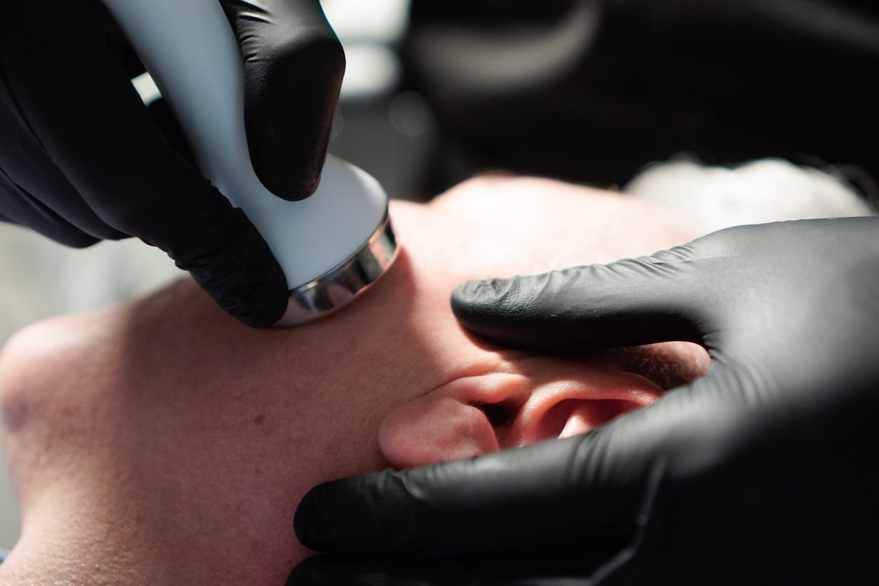 Aplicación de toxina botulínica con dosis medidas en la clínica del Dr. Bidot
